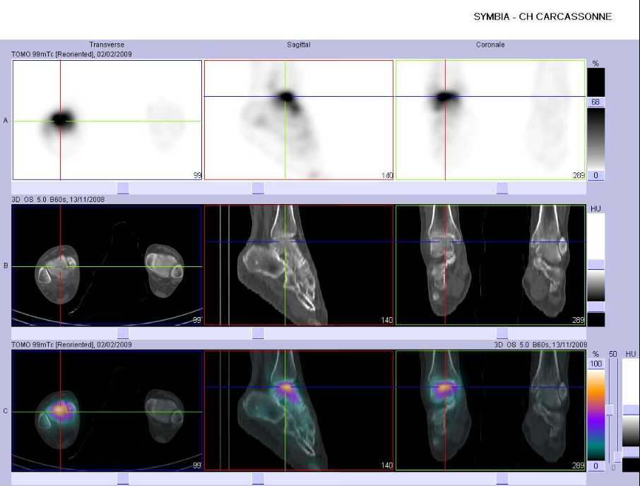 Fracture du talus droit