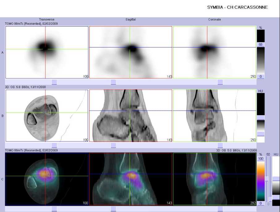 Fracture du talus droit
