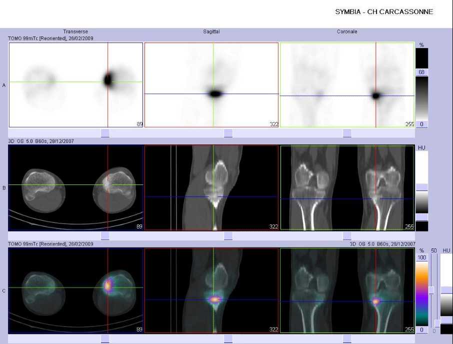 Fracture de fatigue du tiers sup&eacute;rieur du tibia gauche