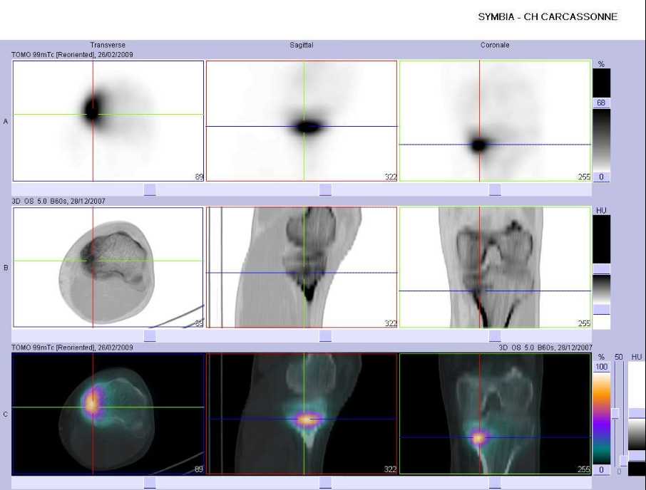 Fracture de fatigue du tiers sup&eacute;rieur du tibia gauche