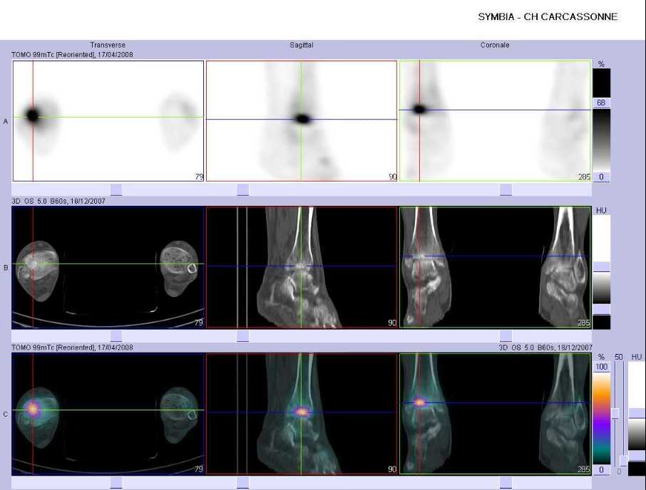 L&eacute;sion ost&eacute;ochondrale du pilon tibial droit