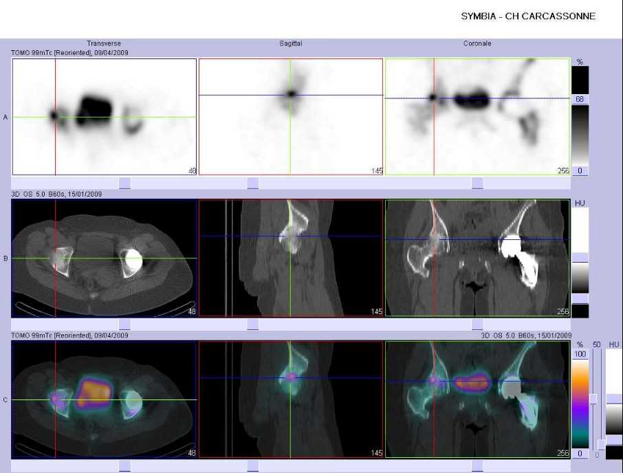 Fracture par insuffisance osseuse de la t&ecirc;te f&eacute;morale droite