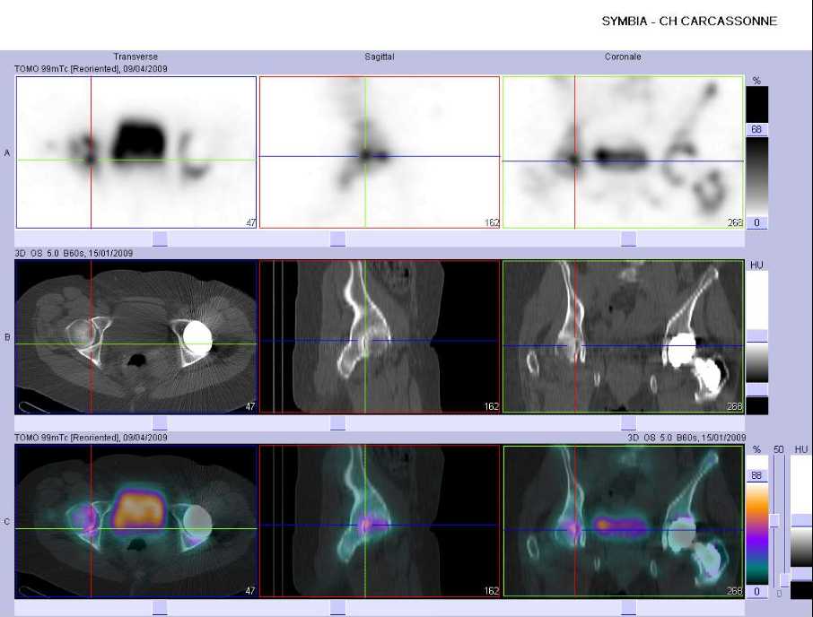 Coxarthrose droite