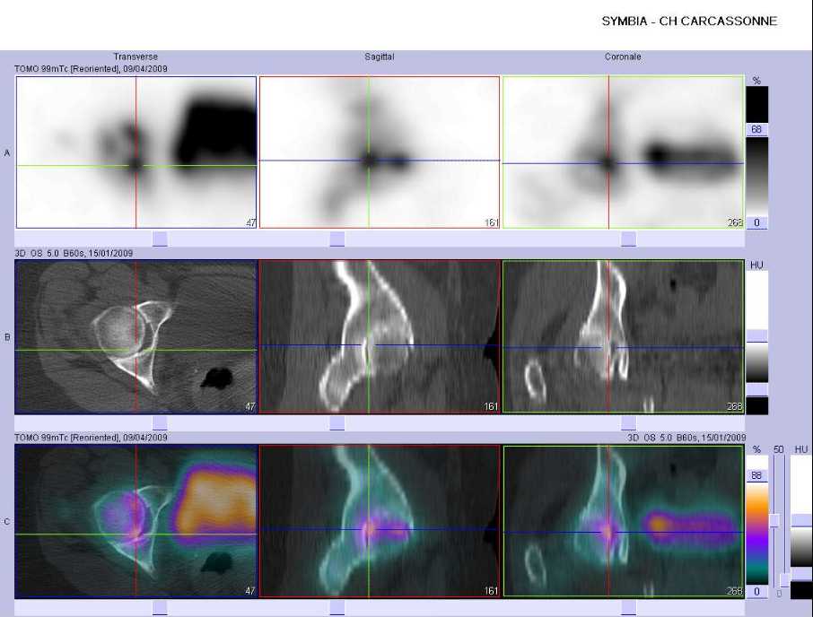 Coxarthrose droite