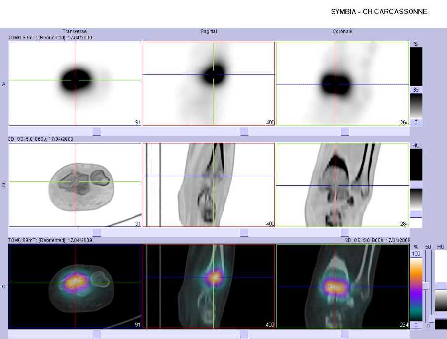 Fracture de l'extr&eacute;mit&eacute; inf&eacute;rieure du radius gauche
