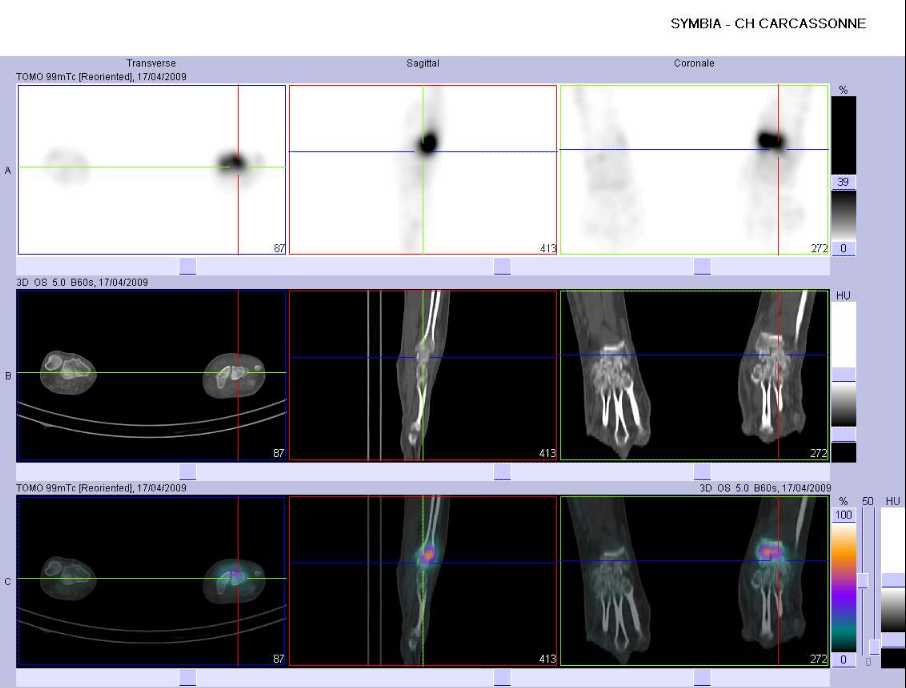 Absence de fracture du lunatum gauche