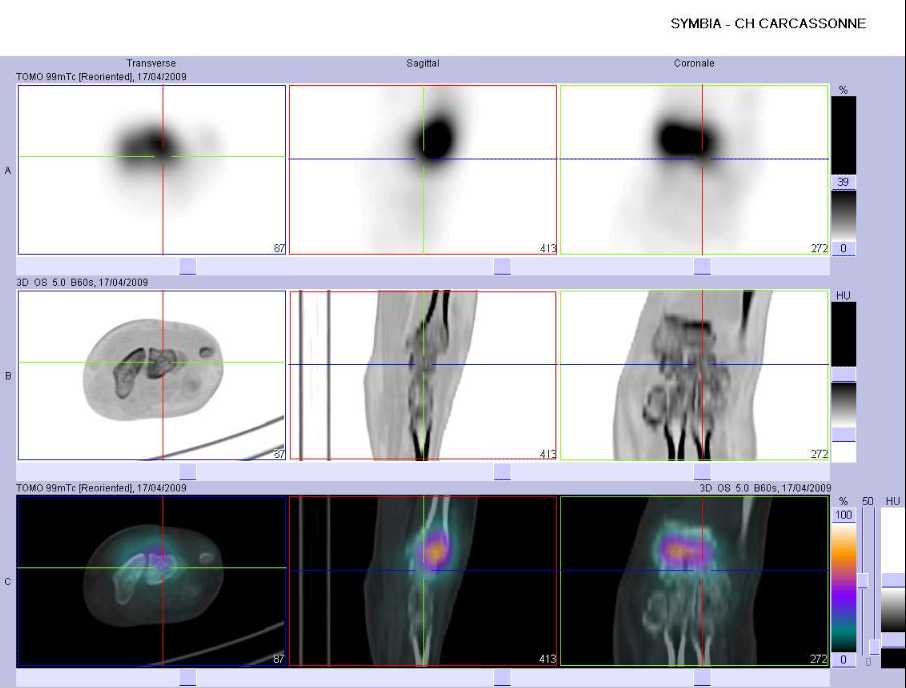 Absence de fracture du lunatum gauche