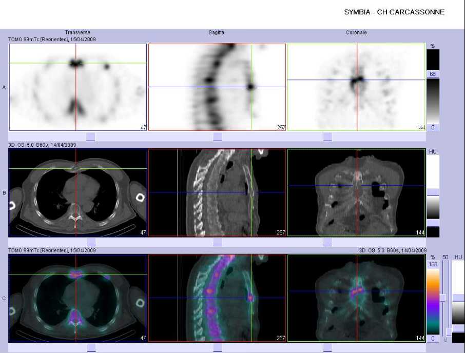 Fracture pathologique du sternum