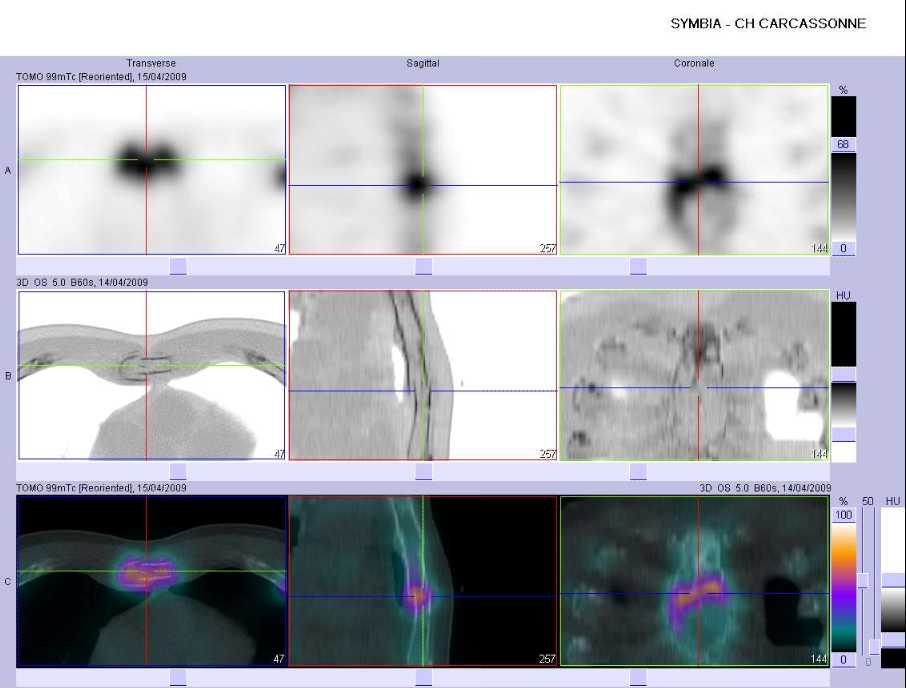 Fracture pathologique du sternum