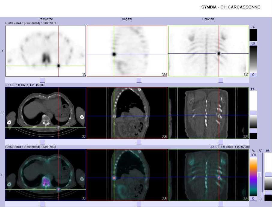 Fracture costale pathologique