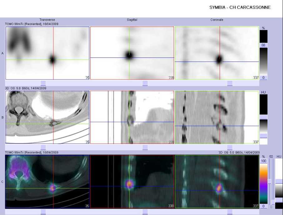 Fracture costale pathologique