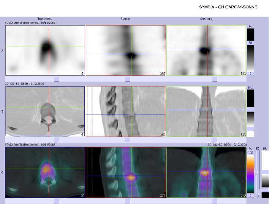 Fracture-tassement du corps vert&eacute;bral de D12