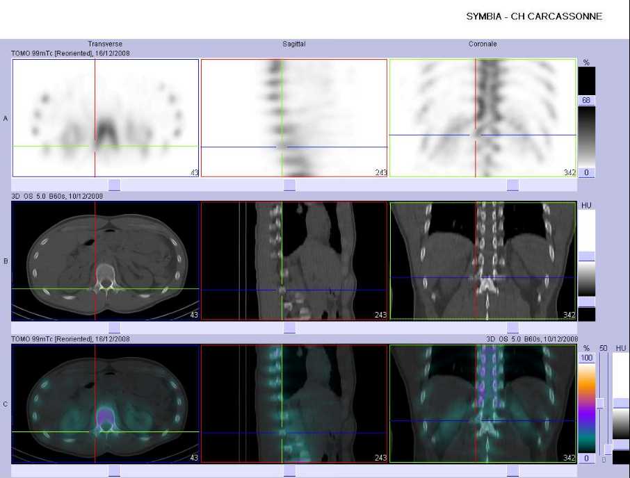 Fracture de l'apophyse transverse droite de L1