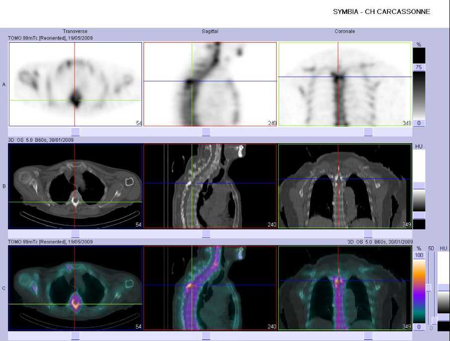 M&eacute;tastase ost&eacute;ocondensante de l'arc post&eacute;rieur d'une vert&egrave;bre dorsale haute