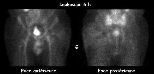 Leukoscan 6 h
