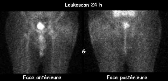 Leukoscan 24 h