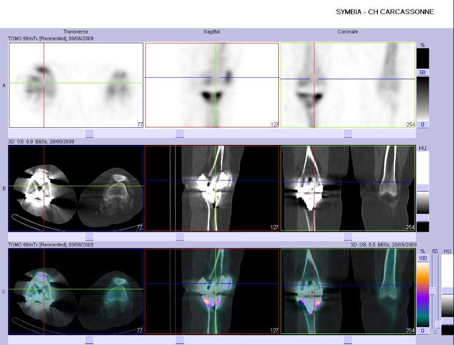 Absence de conflit en regard de la composante f&eacute;morale et patellaire de la PTG