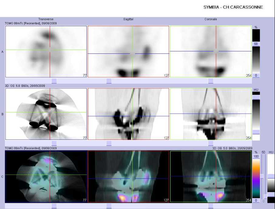 Absence de conflit en regard de la composante f&eacute;morale et patellaire de la PTG