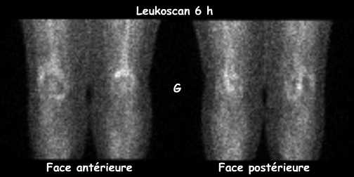 Leukoscan 6 h