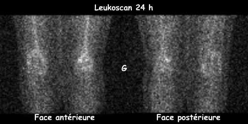 Leukoscan 24 h