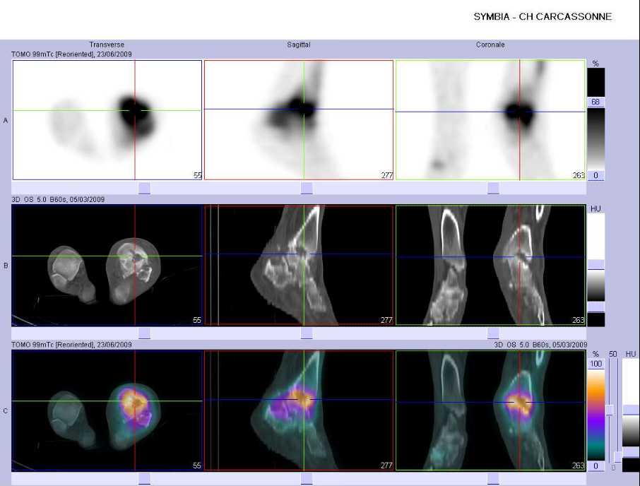 Importante l&eacute;sion &eacute;rosive du pilon tibial gauche