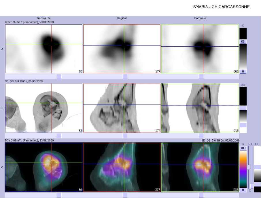 Importante l&eacute;sion &eacute;rosive du pilon tibial gauche