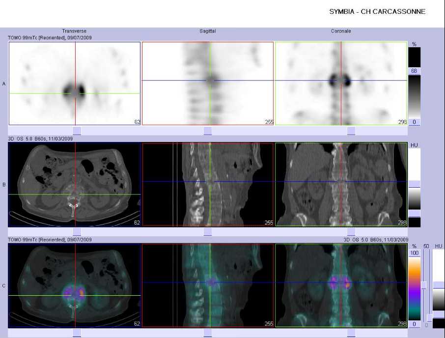 Spondylodiscite L2-L3