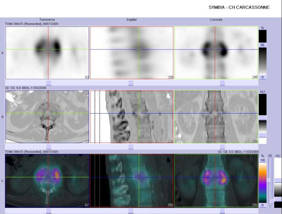 Spondylodiscite L2-L3
