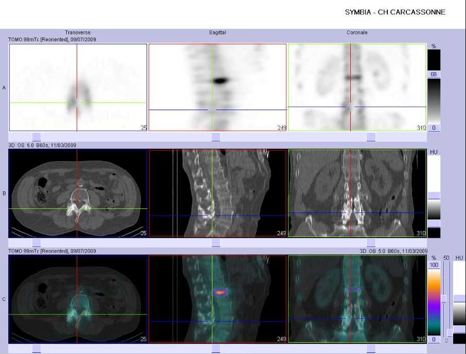 Arthrose &eacute;volutive des articulaires post&eacute;rieures de L3 &agrave; L5