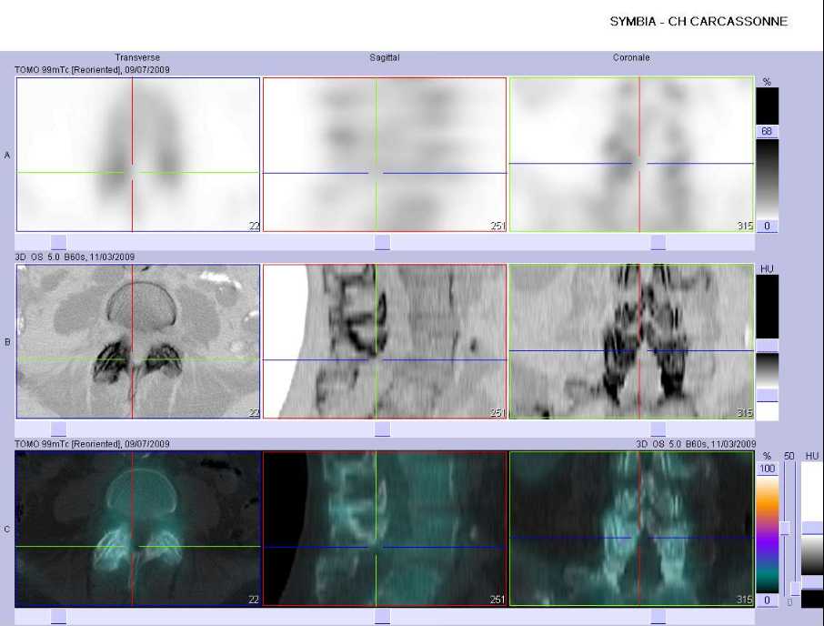 Arthrose &eacute;volutive des articulaires post&eacute;rieures de L3 &agrave; L5