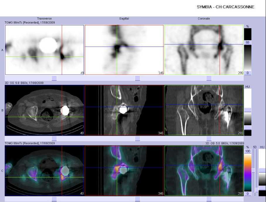 Fracture du cotyle gauche