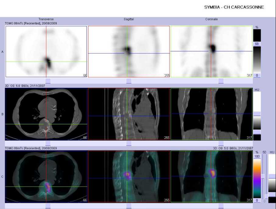 M&eacute;tastase mixte du corps vert&eacute;bral d'une vert&egrave;bre thoracique moyenne