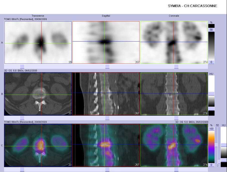 Discopathie arthrosique 