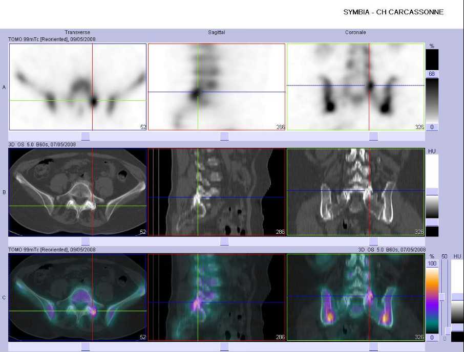 Arthrose des articulaires post&eacute;rieures