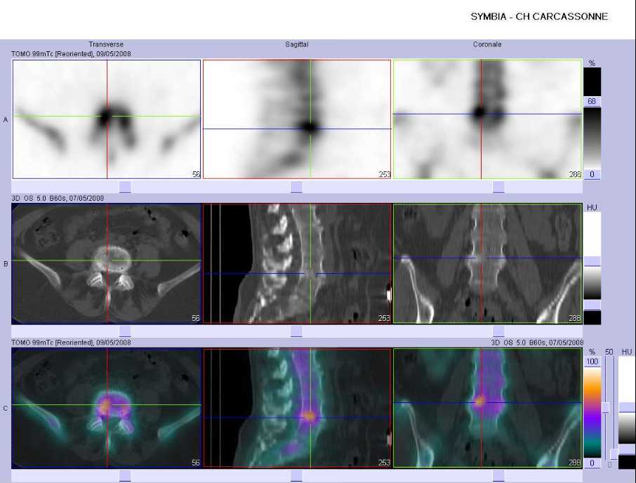 Arthrose L4-L5