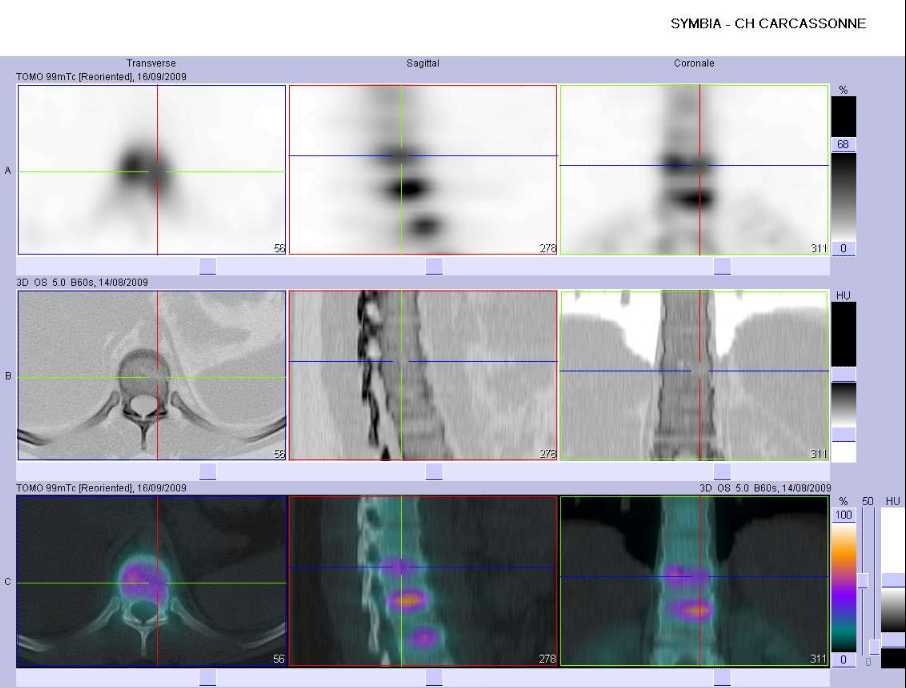 Fracture-tassement du corps vert&eacute;bral de T10