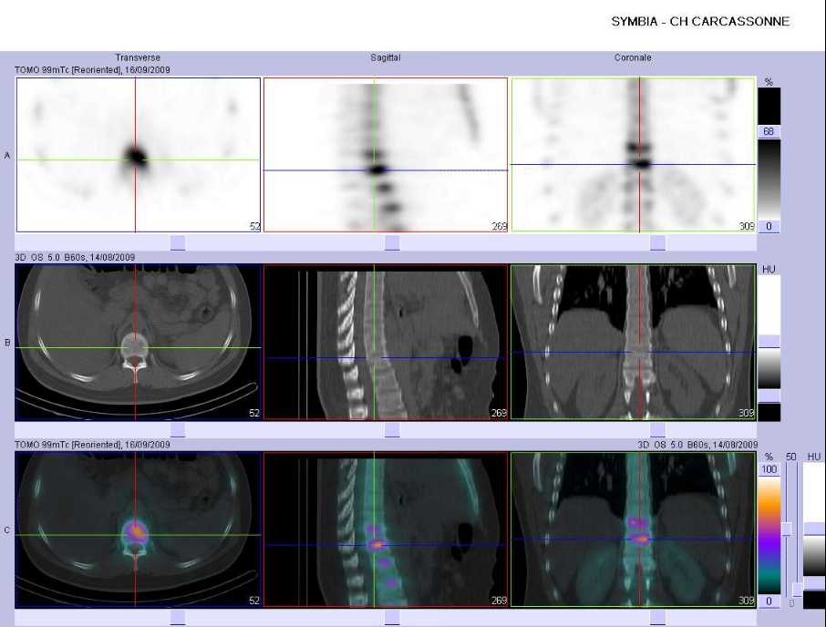 Fracture-tassement du corps vert&eacute;bral de T11