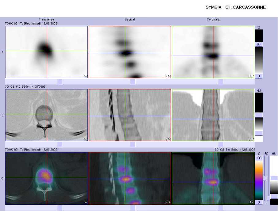Fracture-tassement du corps vert&eacute;bral de T11