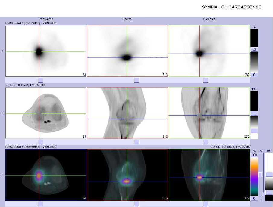 Fracture par insuffisance osseuse sous-chondrale en regard du condyle f&eacute;moral m&eacute;dial gauche
