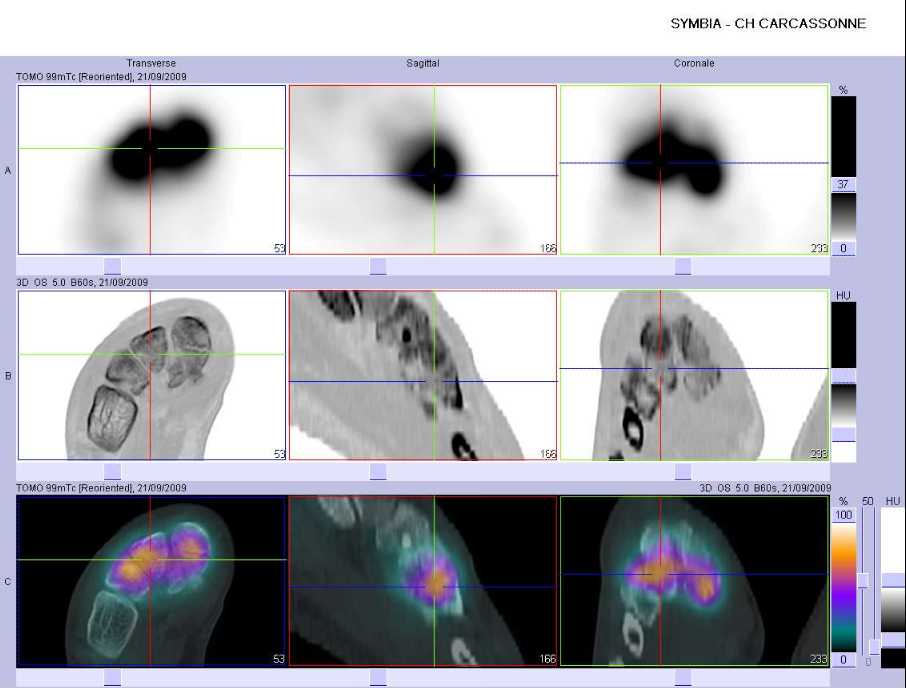 Fracture de la base du deuxi&egrave;me m&eacute;tatarsien droit