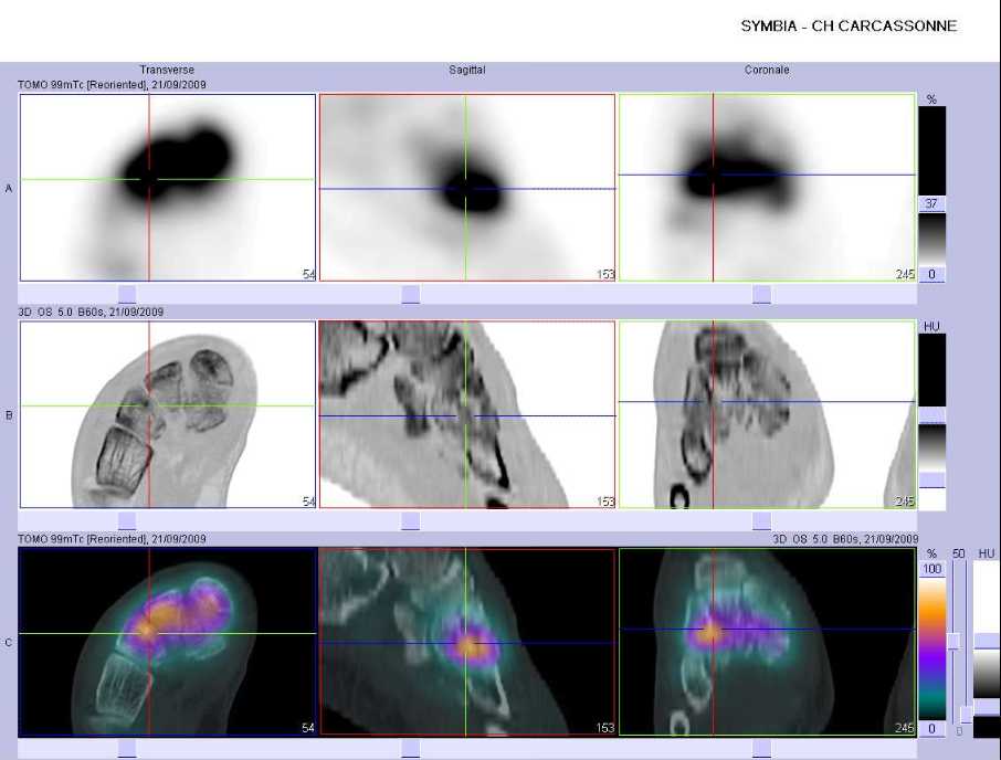 Fracture de la base du troisi&egrave;me m&eacute;tatarsien droit