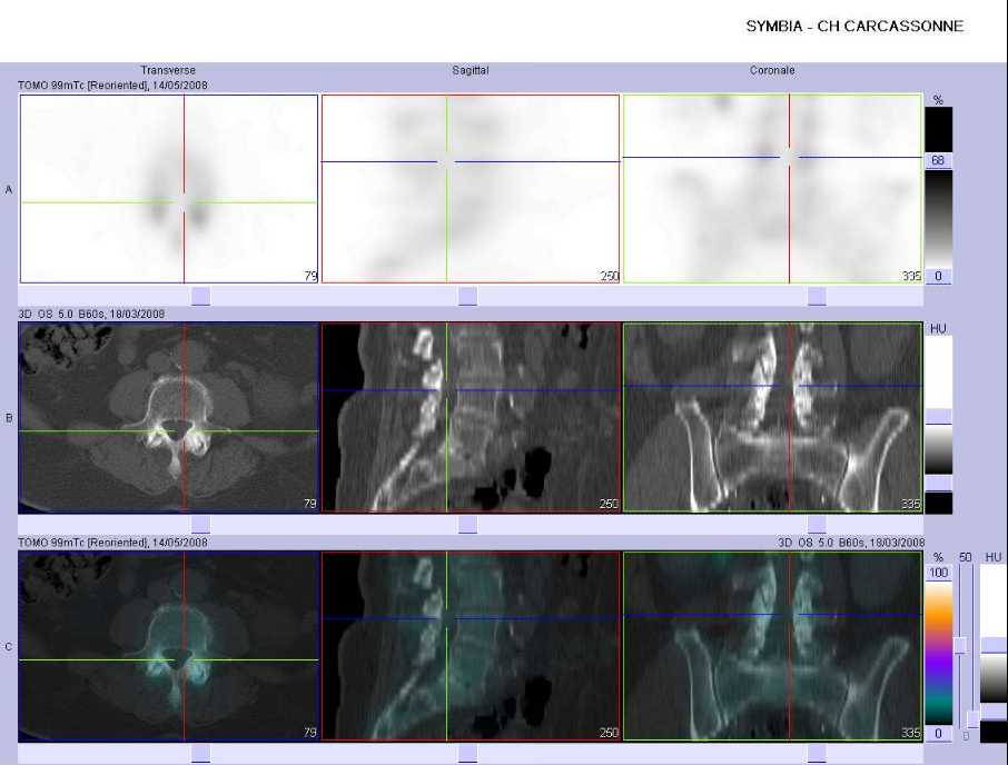 Arthrose des facettes articulaires post&eacute;rieures de L4